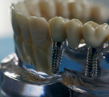 Quelle: Initiative proDente_Zahnersatz auf Zahnimplantaten