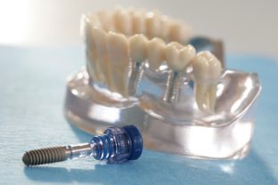 Lebensqualität durch ein Zahnimplantat | © Initiative proDente e.V.