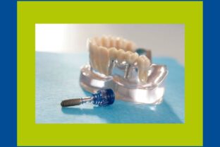 Zahnimplantate schließen nicht nur Zahnlücken: Sie geben ein großes Stück Lebensqualität zurück. Erfahren Sie hier mehr über unsere Versorgung.