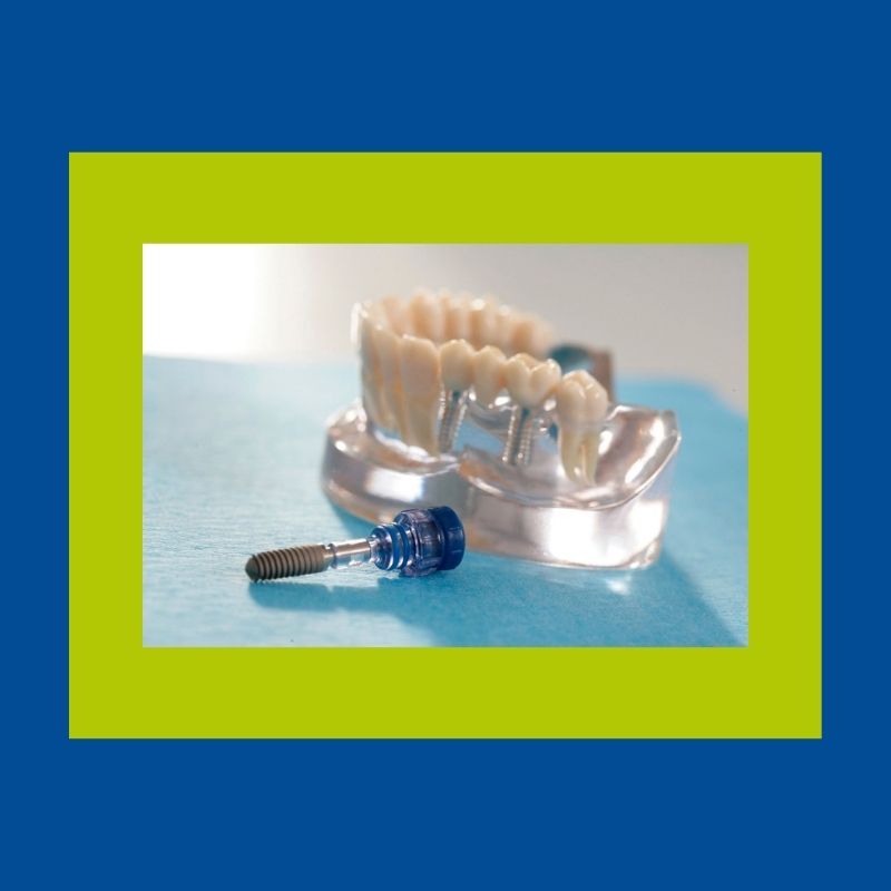 Zahnimplantate schließen nicht nur Zahnlücken: Sie geben ein großes Stück Lebensqualität zurück. Erfahren Sie hier mehr über unsere Versorgung.